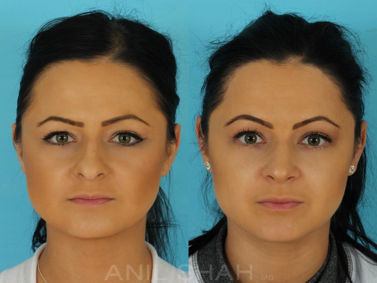Rhinoplasty Before & After Gallery - Patient 316641 - Image 1