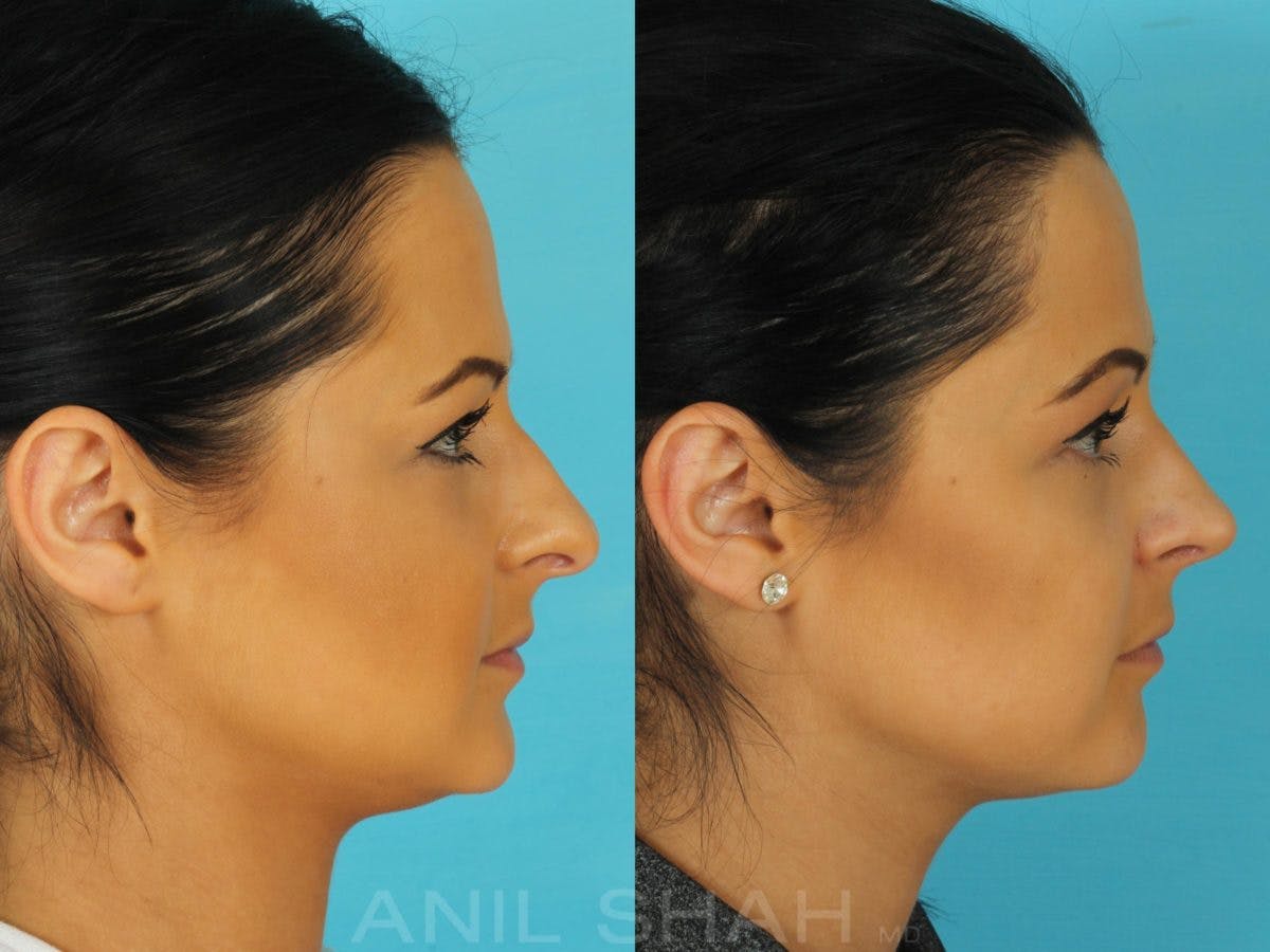 Rhinoplasty Before & After Gallery - Patient 316641 - Image 2