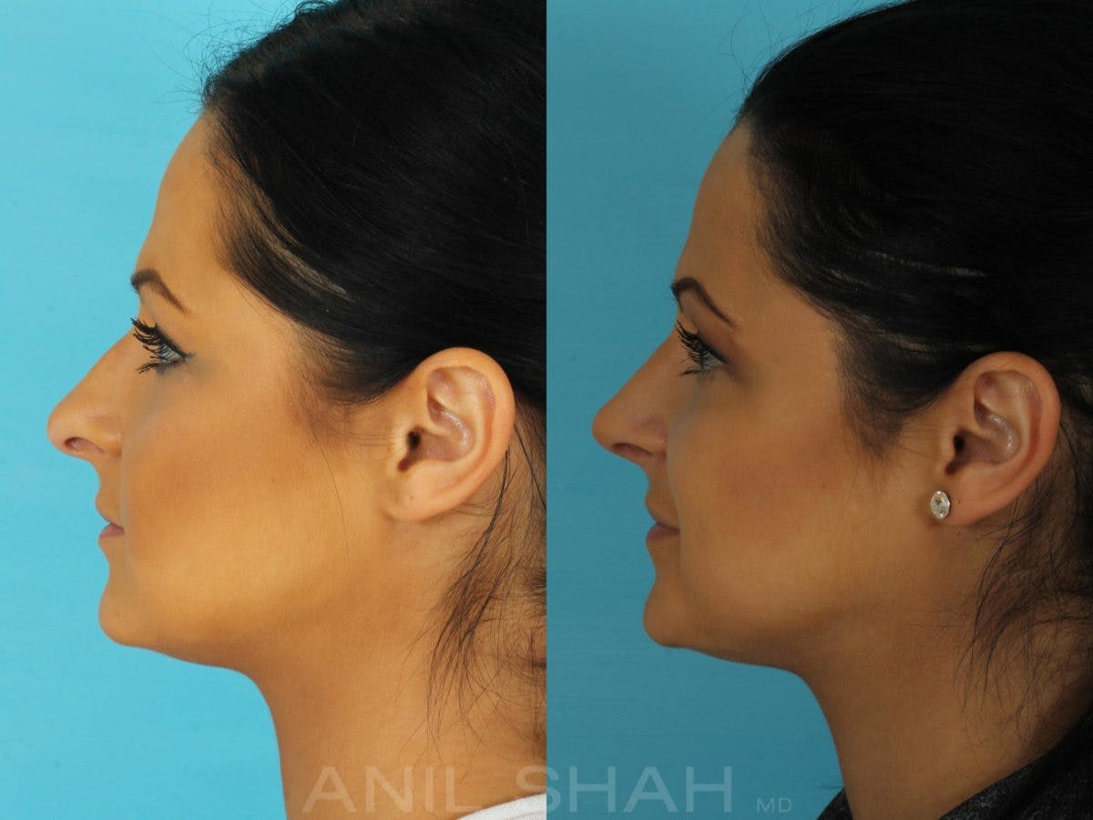 Rhinoplasty Before & After Gallery - Patient 316641 - Image 3