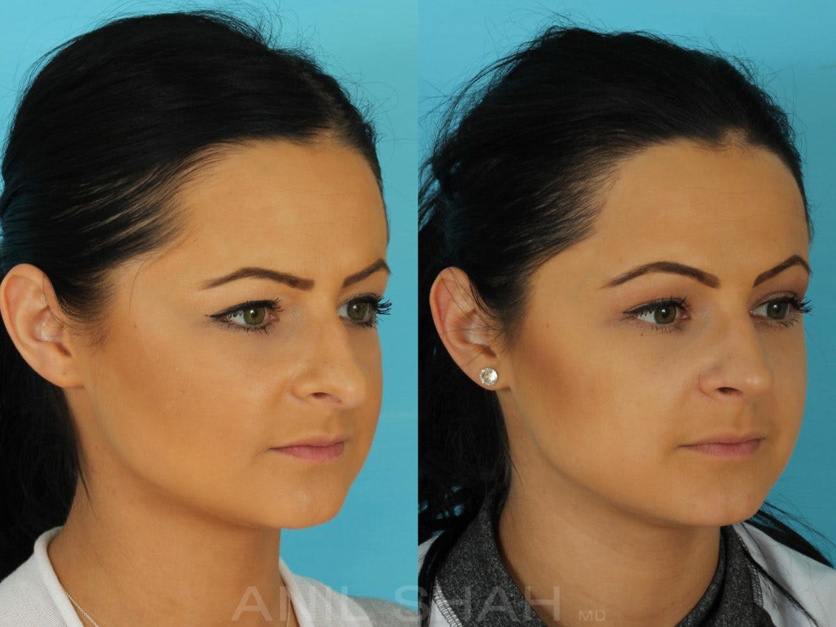Rhinoplasty Before & After Gallery - Patient 316641 - Image 4