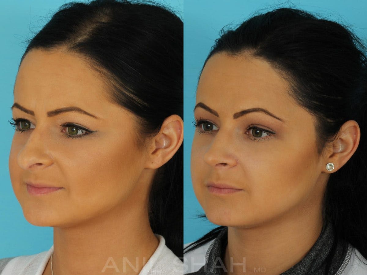 Rhinoplasty Before & After Gallery - Patient 316641 - Image 5