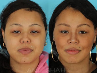 Rhinoplasty Before & After Gallery - Patient 115934 - Image 1