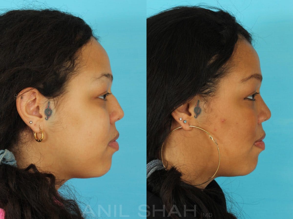 Rhinoplasty Before & After Gallery - Patient 115934 - Image 2