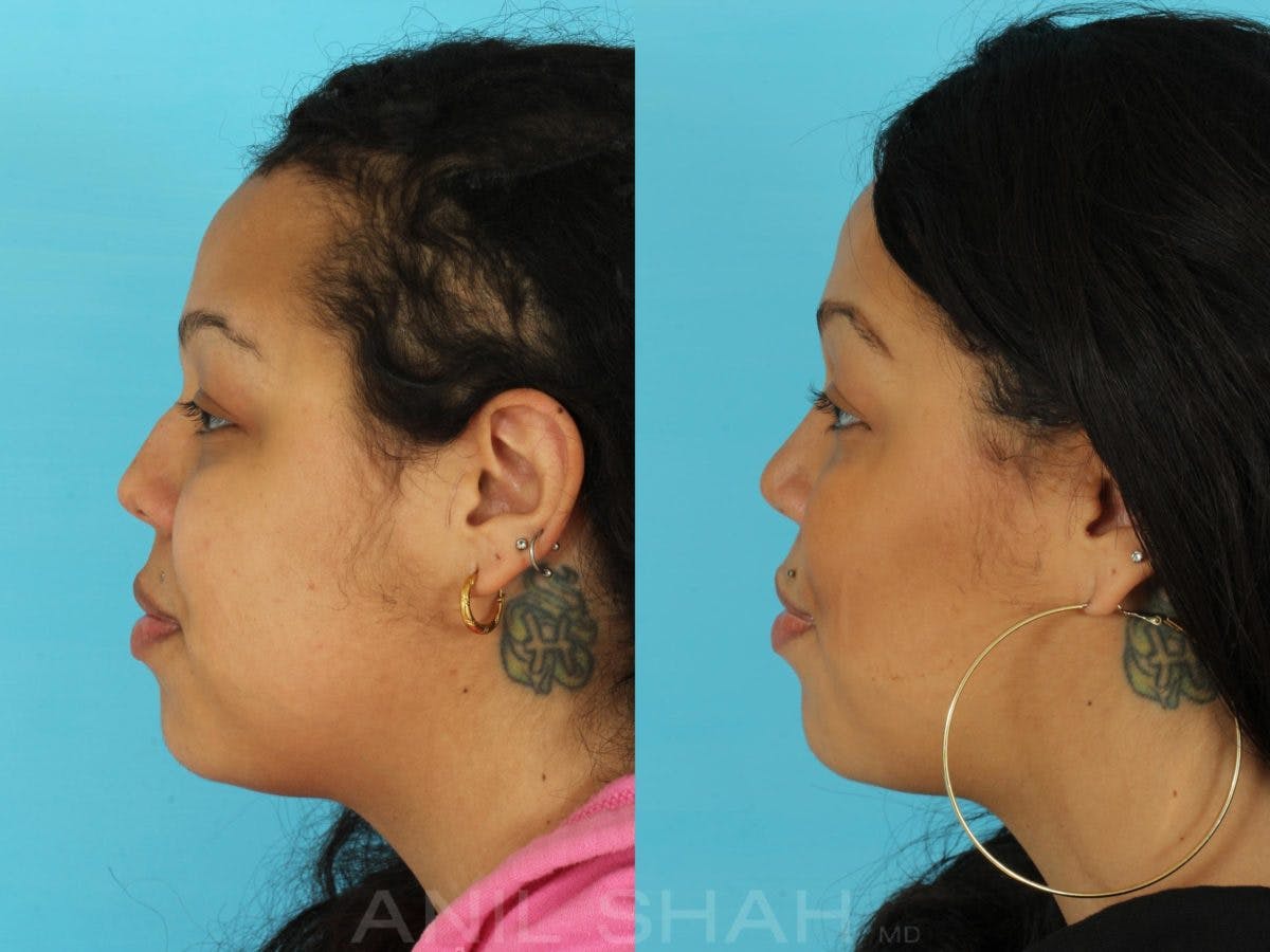 Rhinoplasty Before & After Gallery - Patient 115934 - Image 3