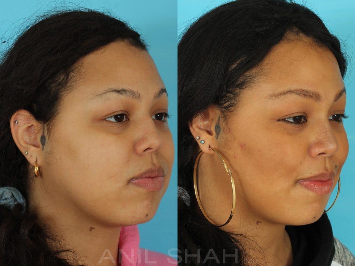 Rhinoplasty Before & After Gallery - Patient 115934 - Image 4