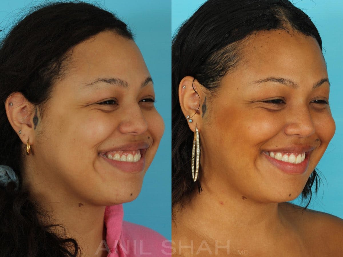 Rhinoplasty Before & After Gallery - Patient 115934 - Image 5