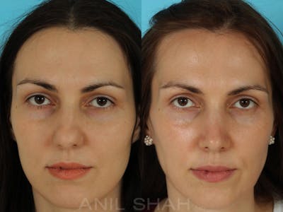 Rhinoplasty Before & After Gallery - Patient 301633 - Image 1