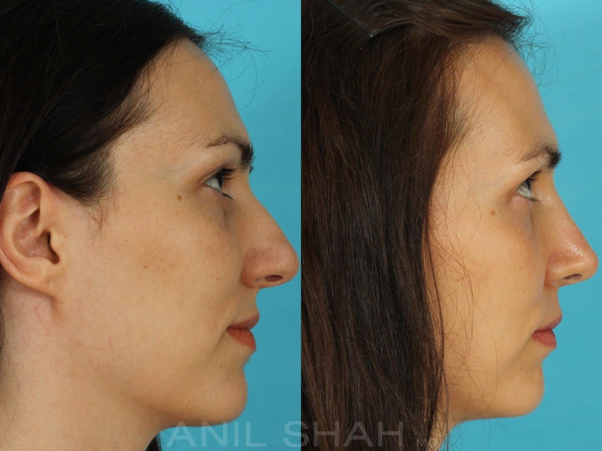 Rhinoplasty Before & After Gallery - Patient 301633 - Image 2