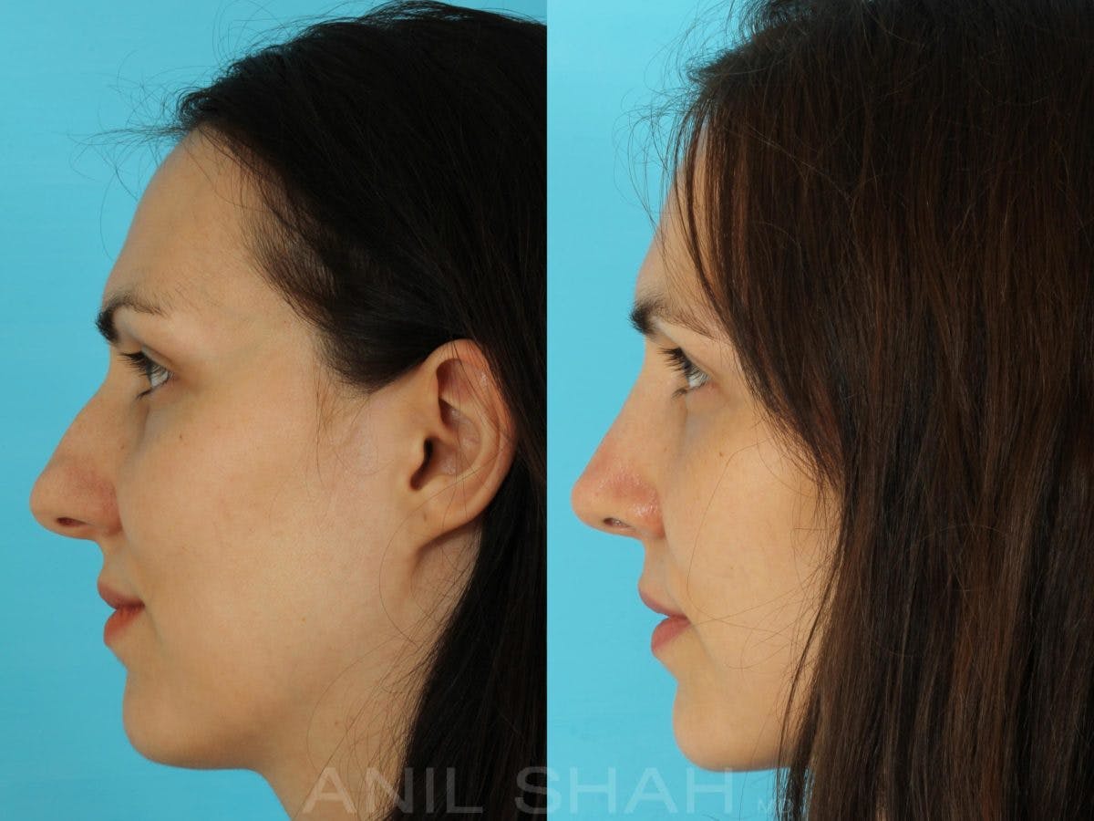 Rhinoplasty Before & After Gallery - Patient 301633 - Image 3