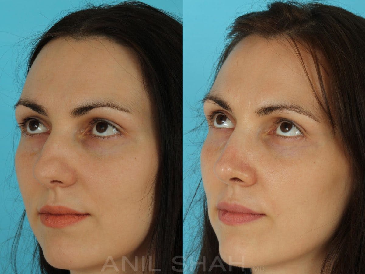 Rhinoplasty Before & After Gallery - Patient 301633 - Image 4