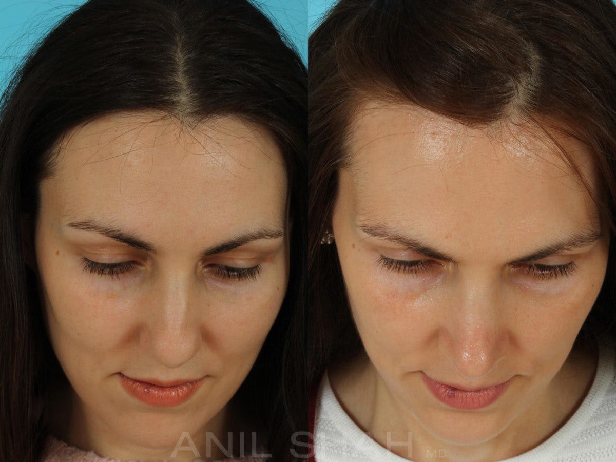 Rhinoplasty Before & After Gallery - Patient 301633 - Image 5