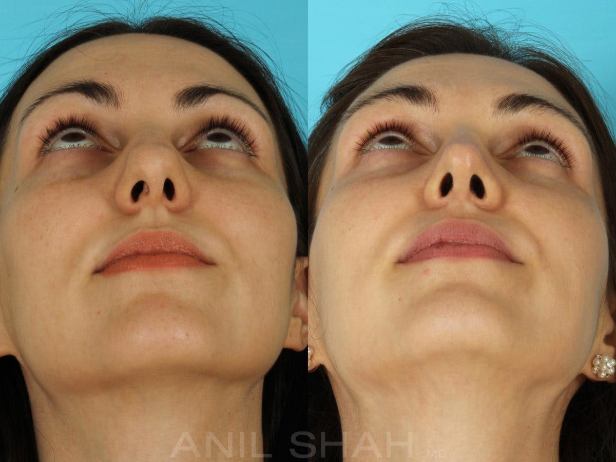 Rhinoplasty Before & After Gallery - Patient 301633 - Image 6
