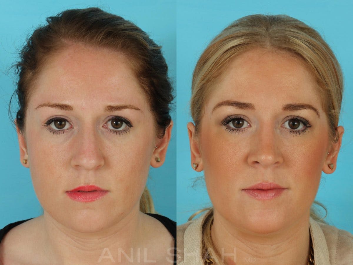 Rhinoplasty Before & After Gallery - Patient 181878 - Image 1