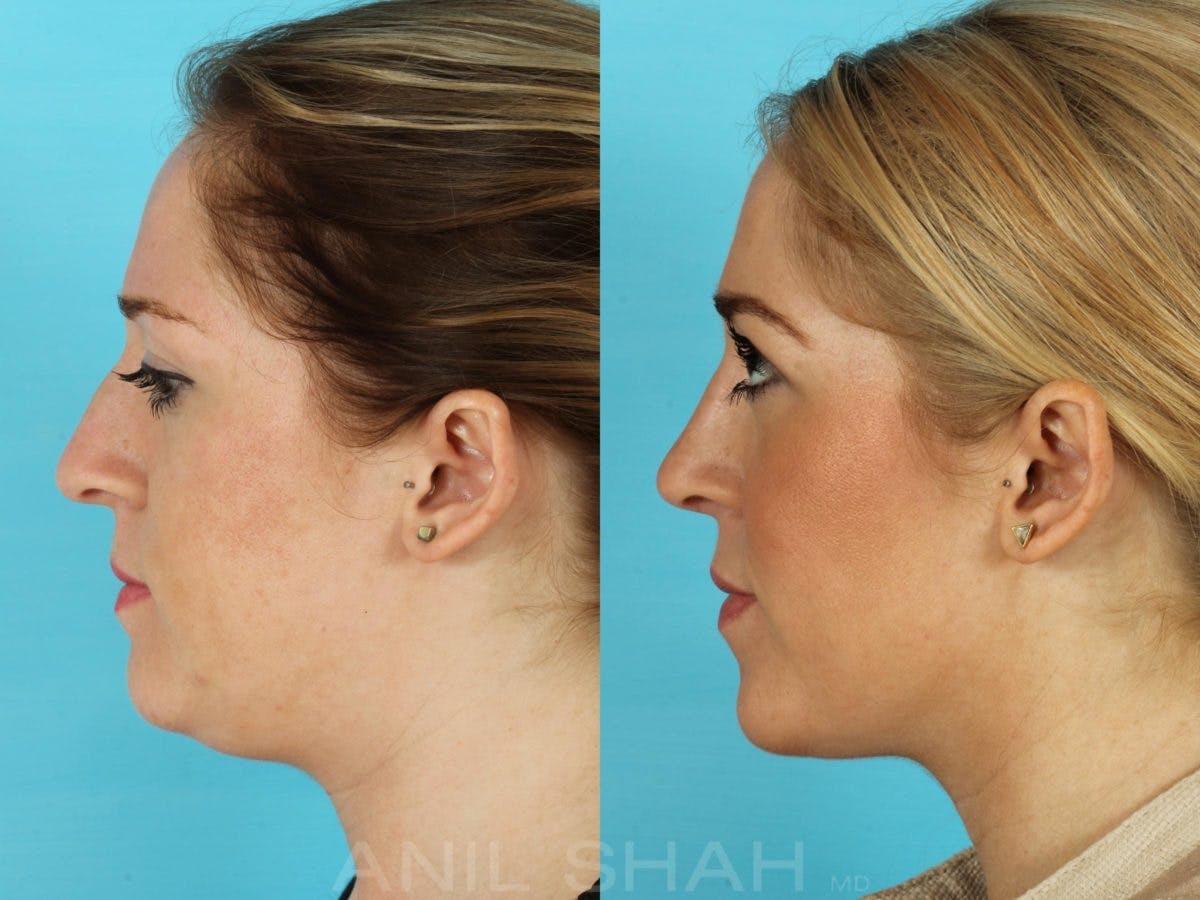 Rhinoplasty Before & After Gallery - Patient 181878 - Image 2