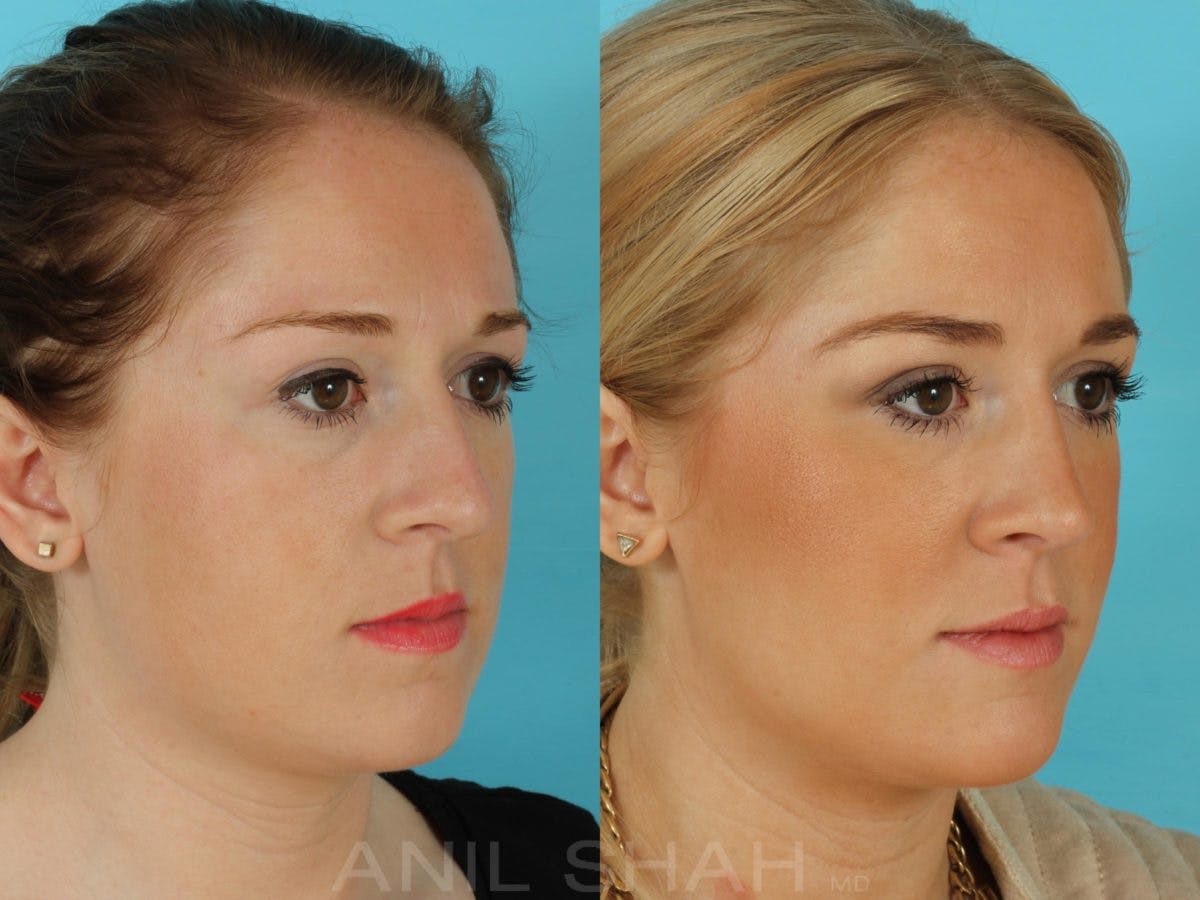 Rhinoplasty Before & After Gallery - Patient 181878 - Image 3