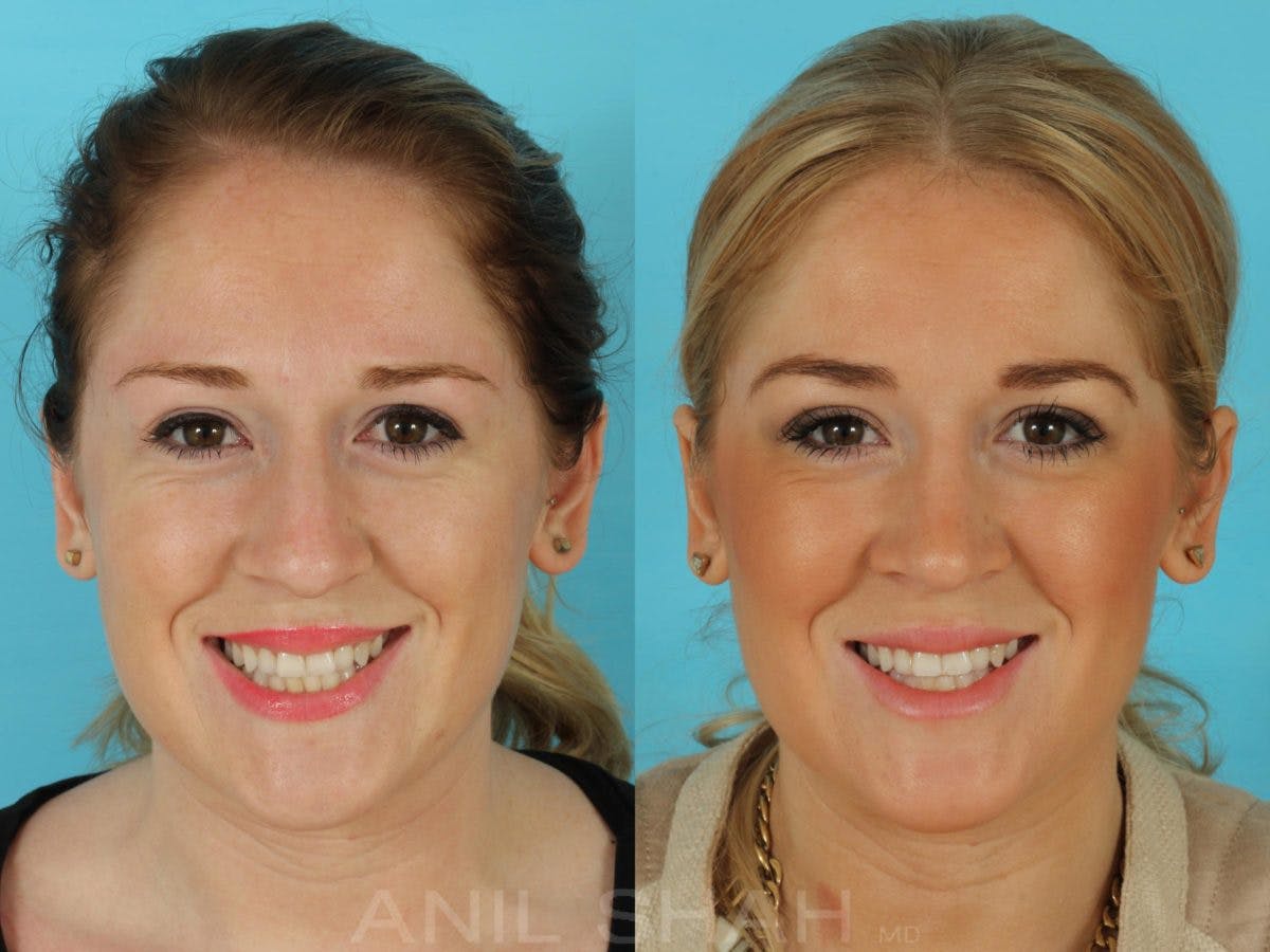 Rhinoplasty Before & After Gallery - Patient 181878 - Image 4