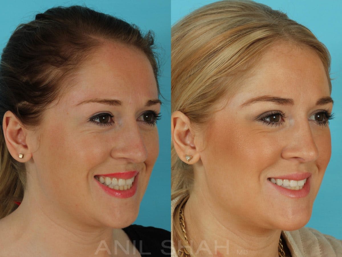 Rhinoplasty Before & After Gallery - Patient 181878 - Image 5