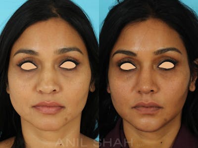 Rhinoplasty Before & After Gallery - Patient 318565 - Image 1