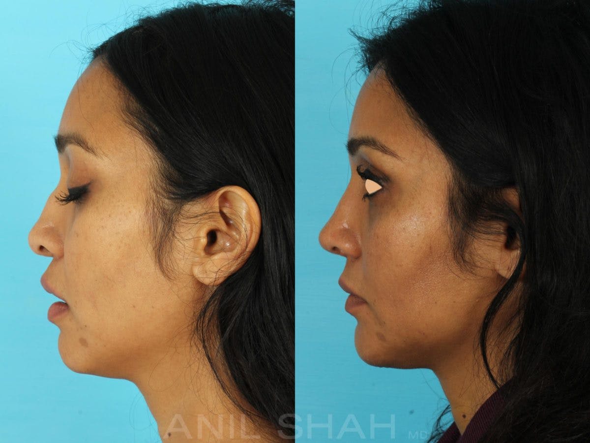 Rhinoplasty Before & After Gallery - Patient 318565 - Image 2