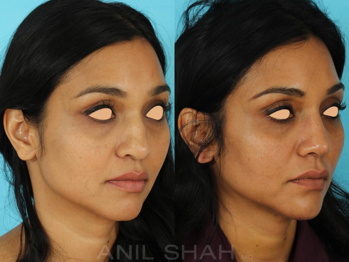 Rhinoplasty Before & After Gallery - Patient 318565 - Image 3