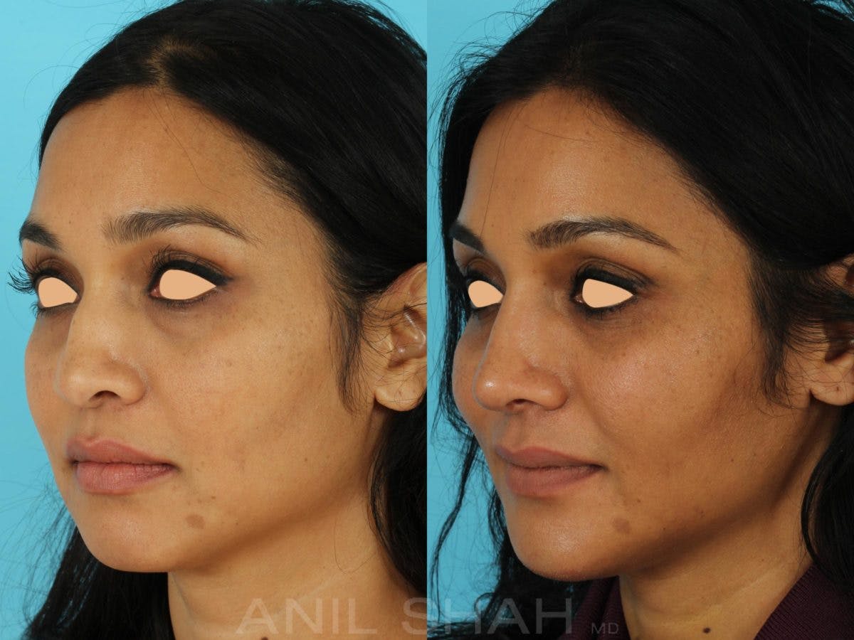 Rhinoplasty Before & After Gallery - Patient 318565 - Image 4