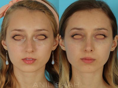 Rhinoplasty Before & After Gallery - Patient 404247 - Image 1