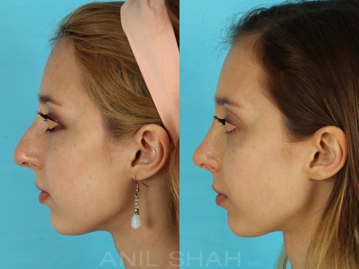 Rhinoplasty Before & After Gallery - Patient 404247 - Image 2