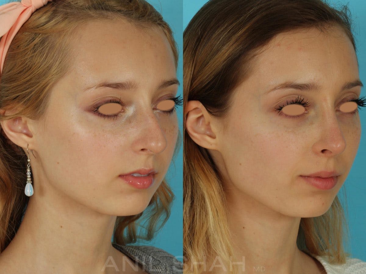 Rhinoplasty Before & After Gallery - Patient 404247 - Image 3