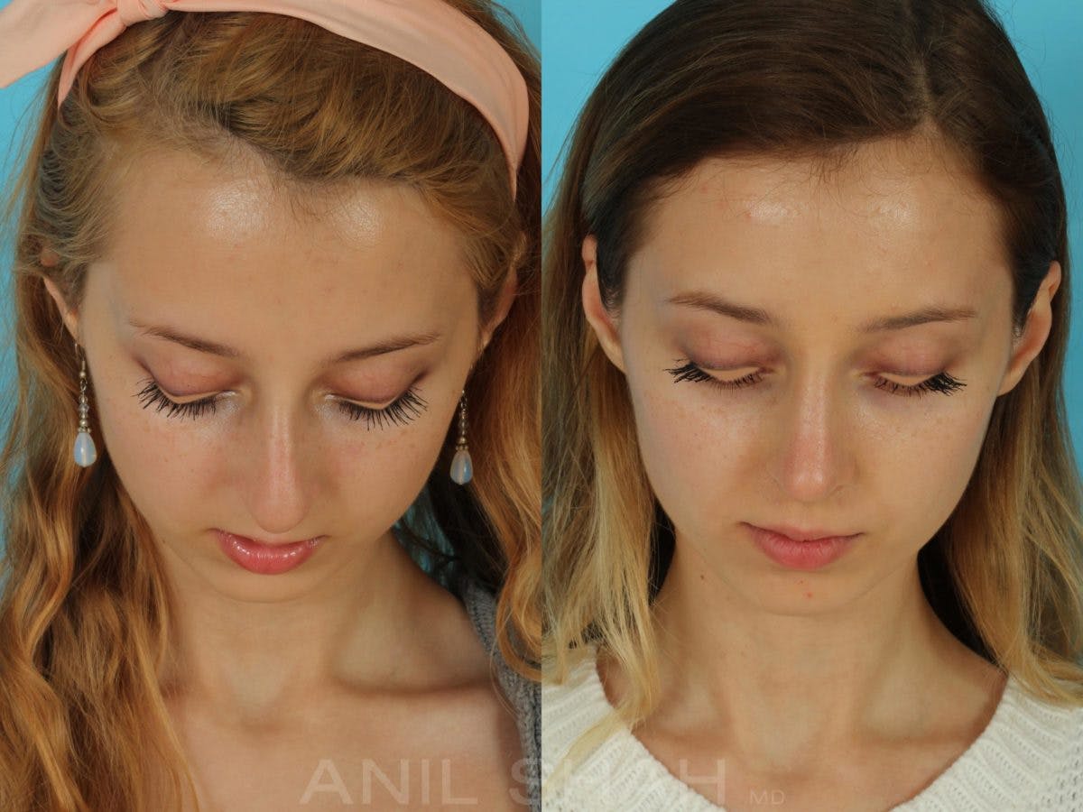 Rhinoplasty Before & After Gallery - Patient 404247 - Image 4
