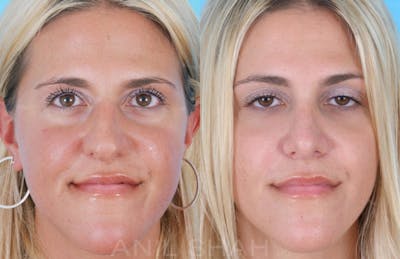 Rhinoplasty Before & After Gallery - Patient 109029 - Image 1