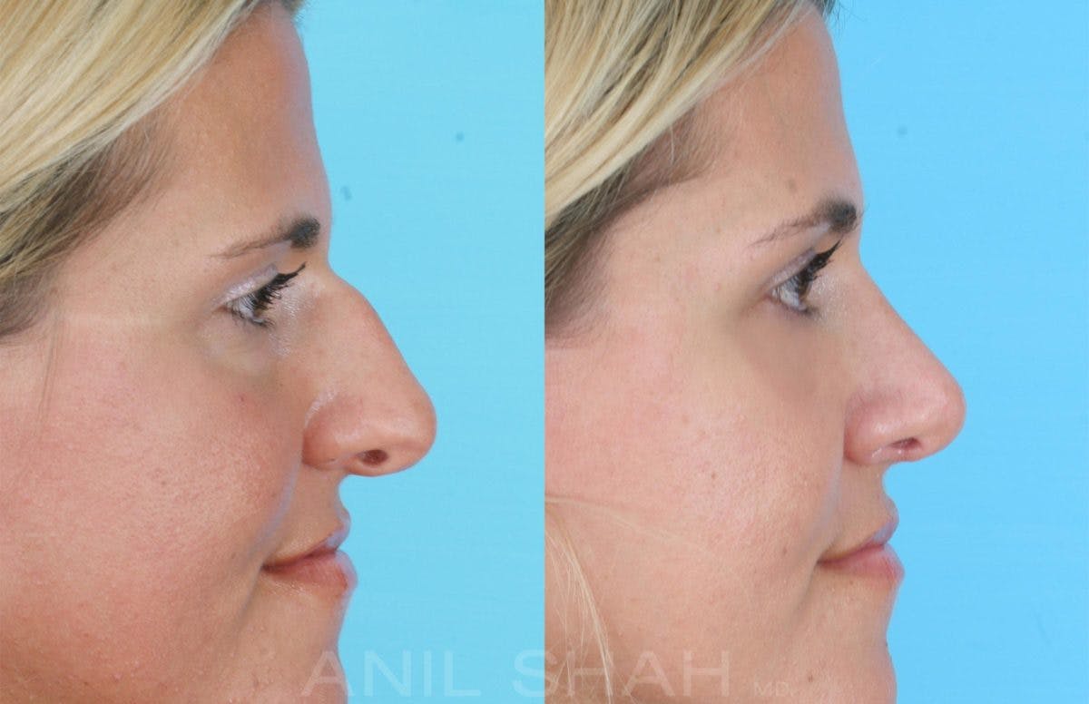 Rhinoplasty Before & After Gallery - Patient 109029 - Image 2