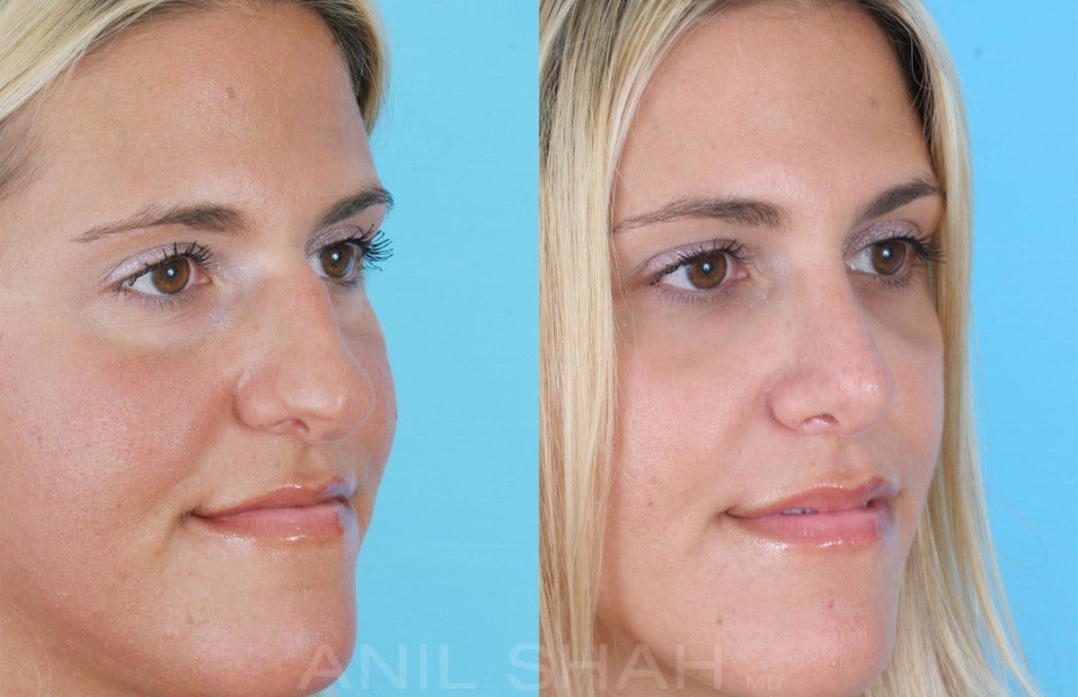 Rhinoplasty Before & After Gallery - Patient 109029 - Image 3