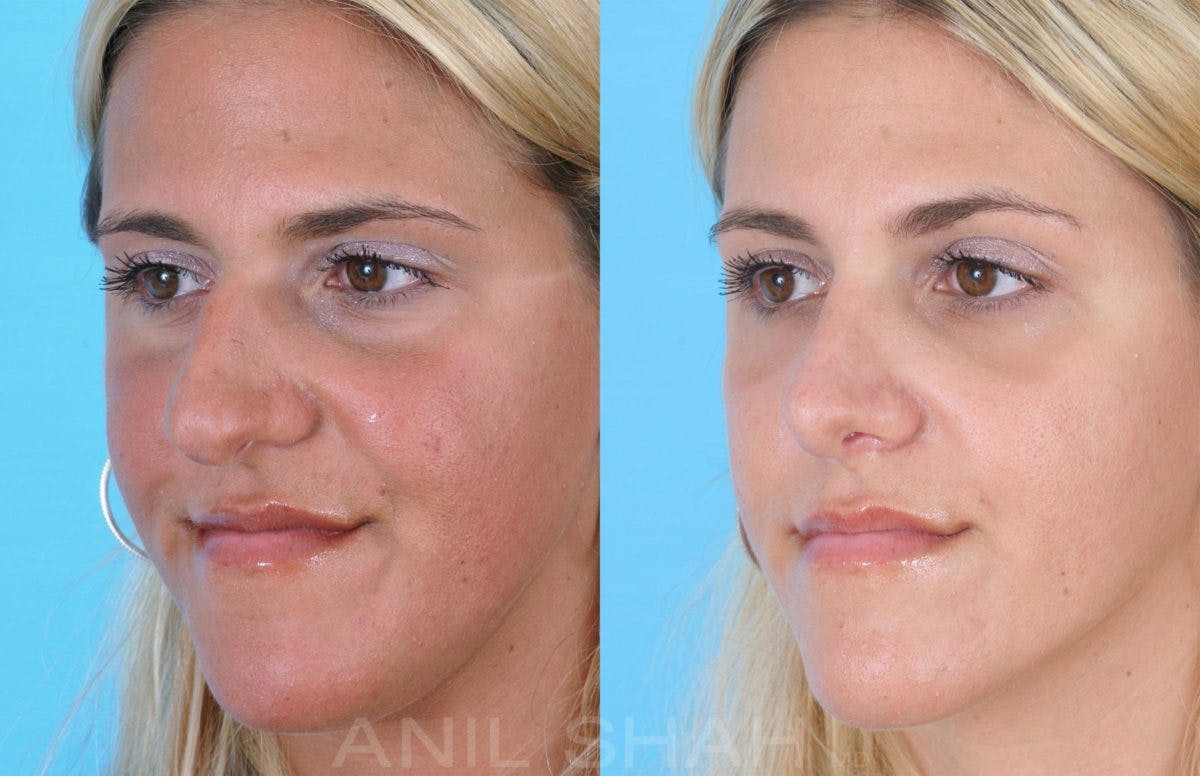 Rhinoplasty Before & After Gallery - Patient 109029 - Image 4