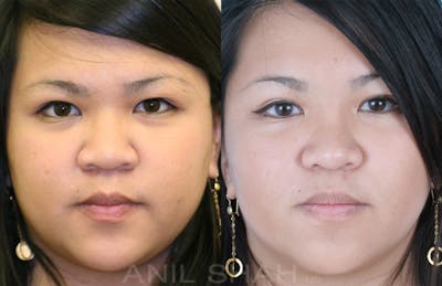 Rhinoplasty Before & After Gallery - Patient 148333 - Image 1