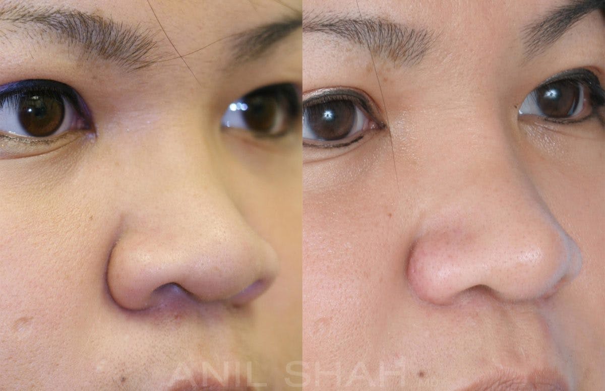 Rhinoplasty Before & After Gallery - Patient 148333 - Image 2