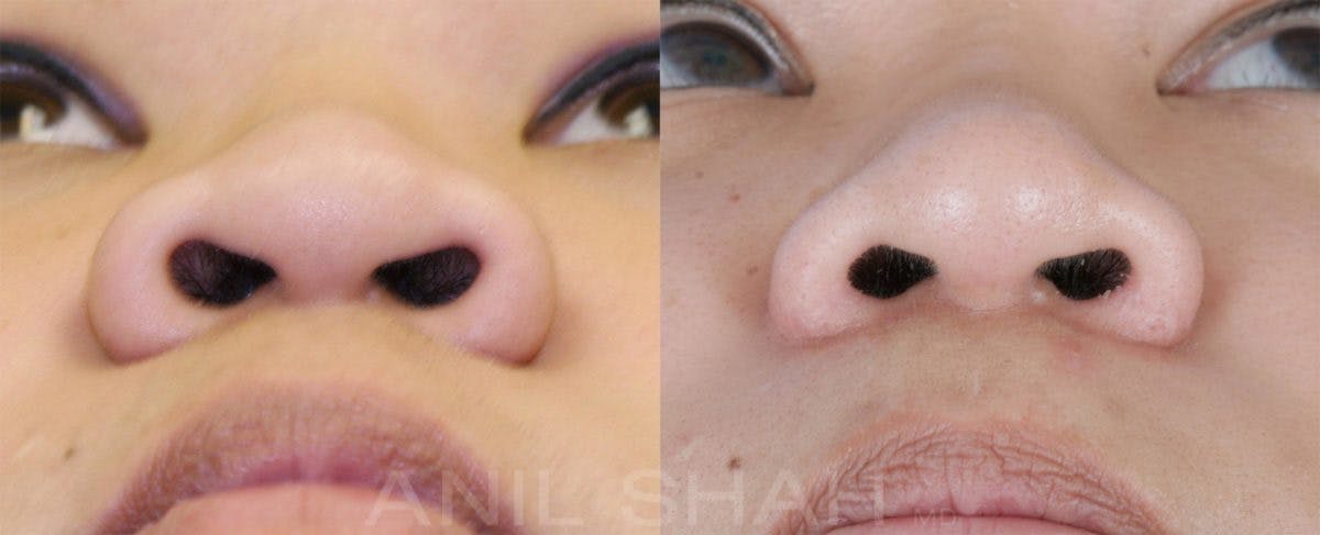 Rhinoplasty Before & After Gallery - Patient 148333 - Image 3