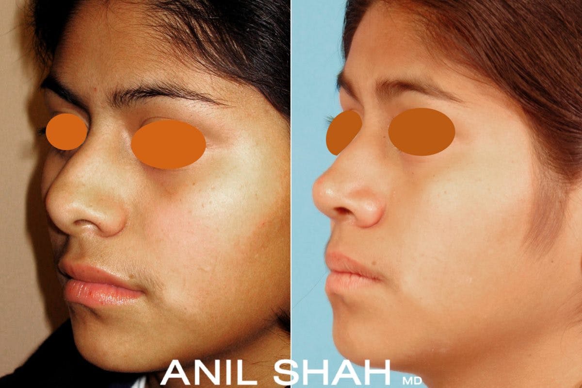 Rhinoplasty Before & After Gallery - Patient 168920 - Image 2