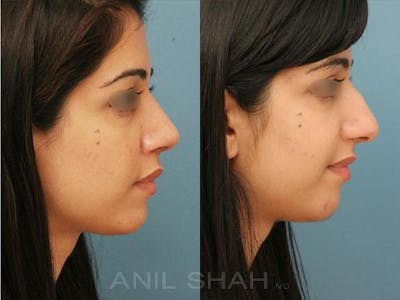 Rhinoplasty Before & After Gallery - Patient 212061 - Image 1