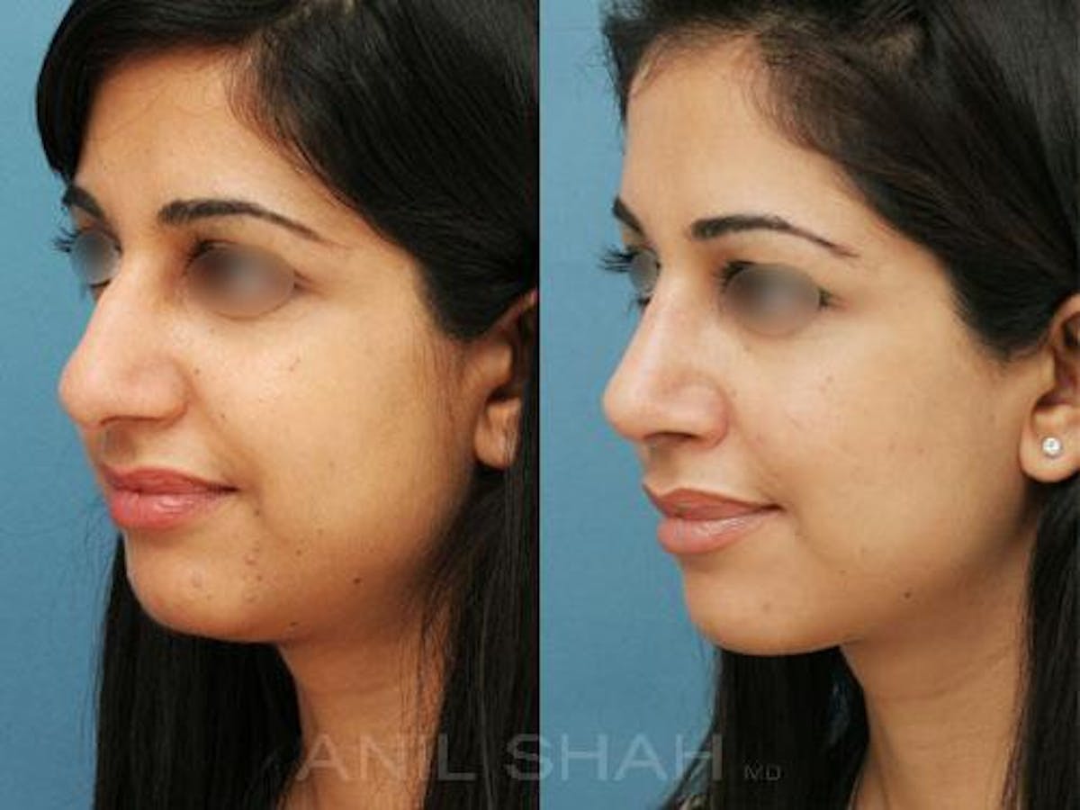 Rhinoplasty Before & After Gallery - Patient 212061 - Image 2