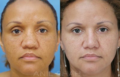 Rhinoplasty Before & After Gallery - Patient 212555 - Image 1