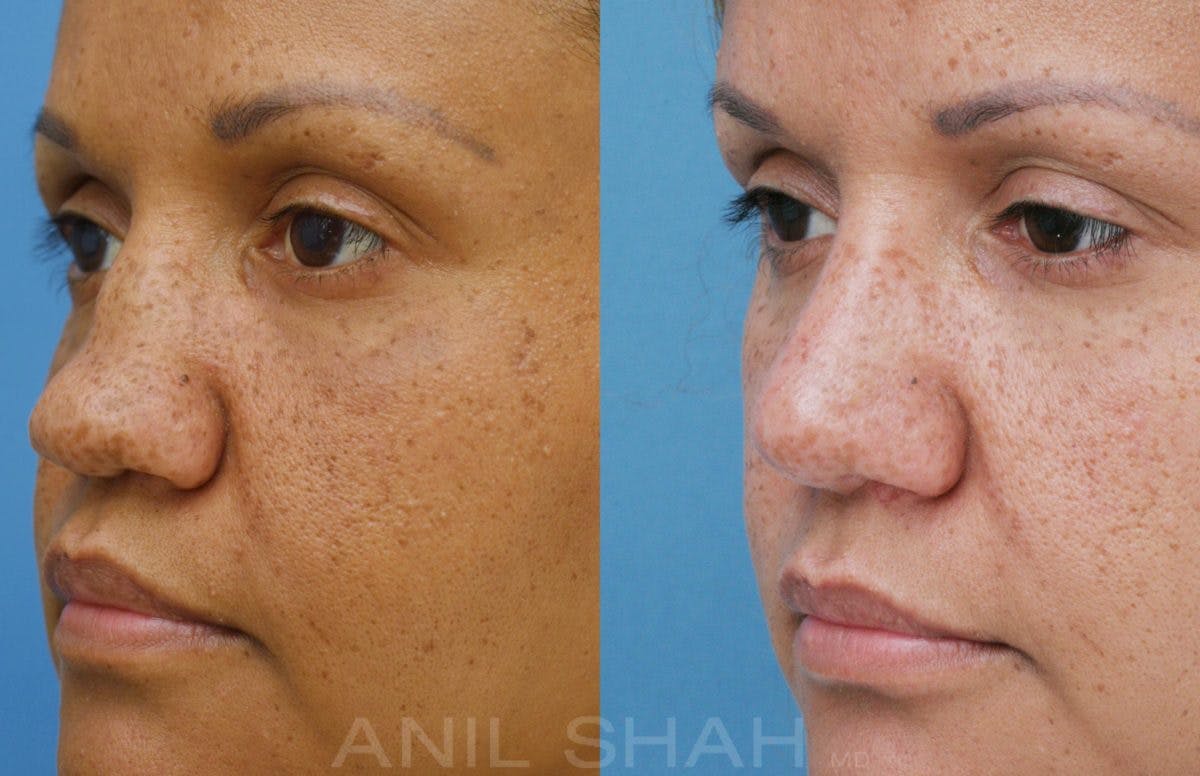 Rhinoplasty Before & After Gallery - Patient 212555 - Image 2