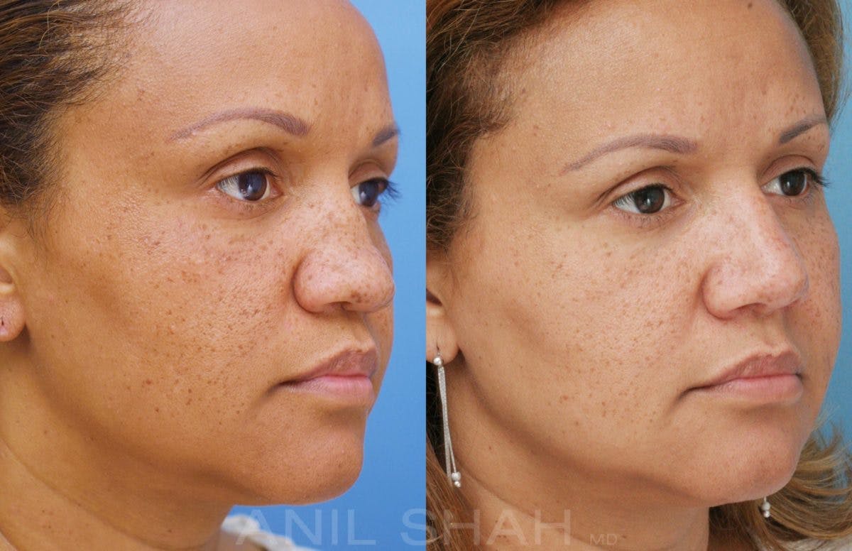Rhinoplasty Before & After Gallery - Patient 212555 - Image 3