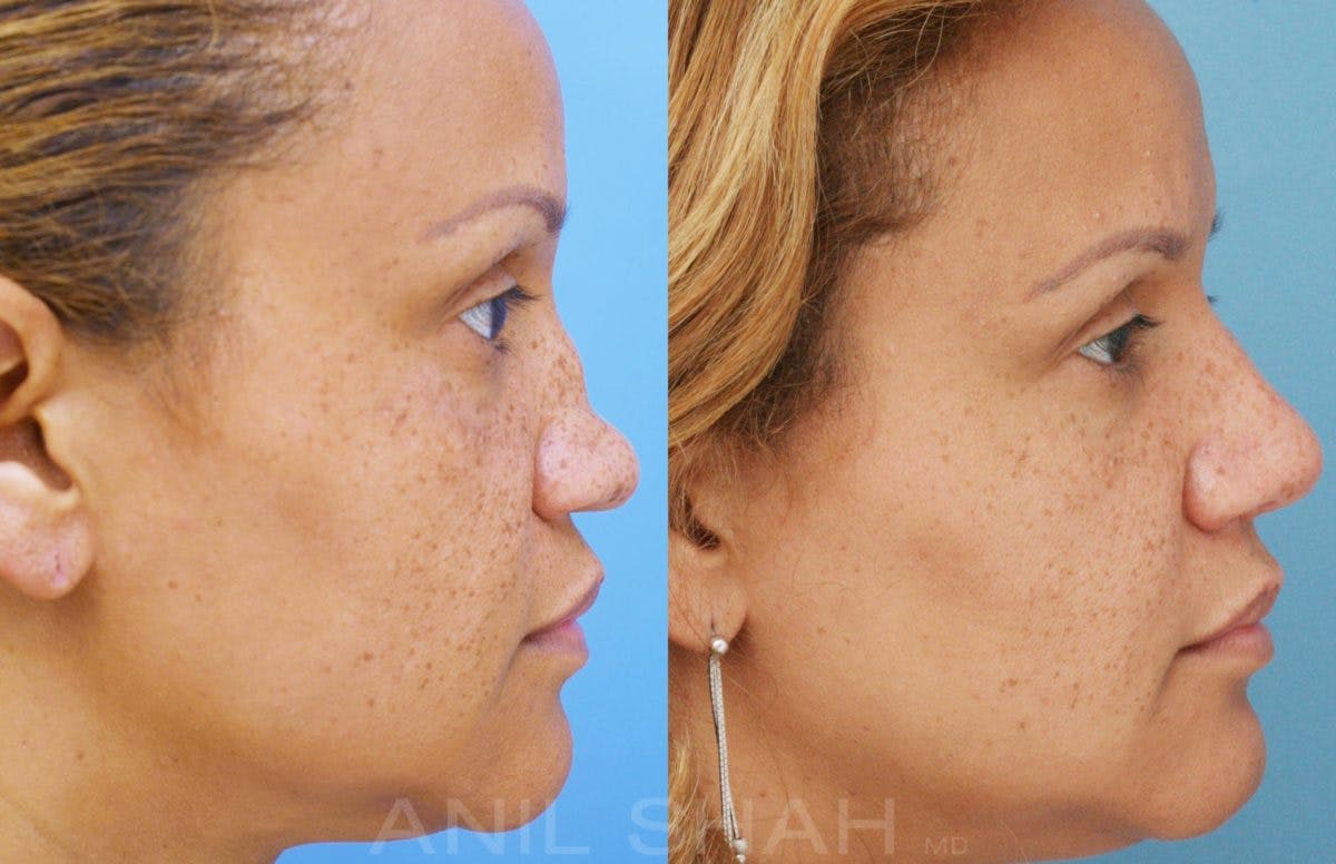 Rhinoplasty Before & After Gallery - Patient 212555 - Image 4