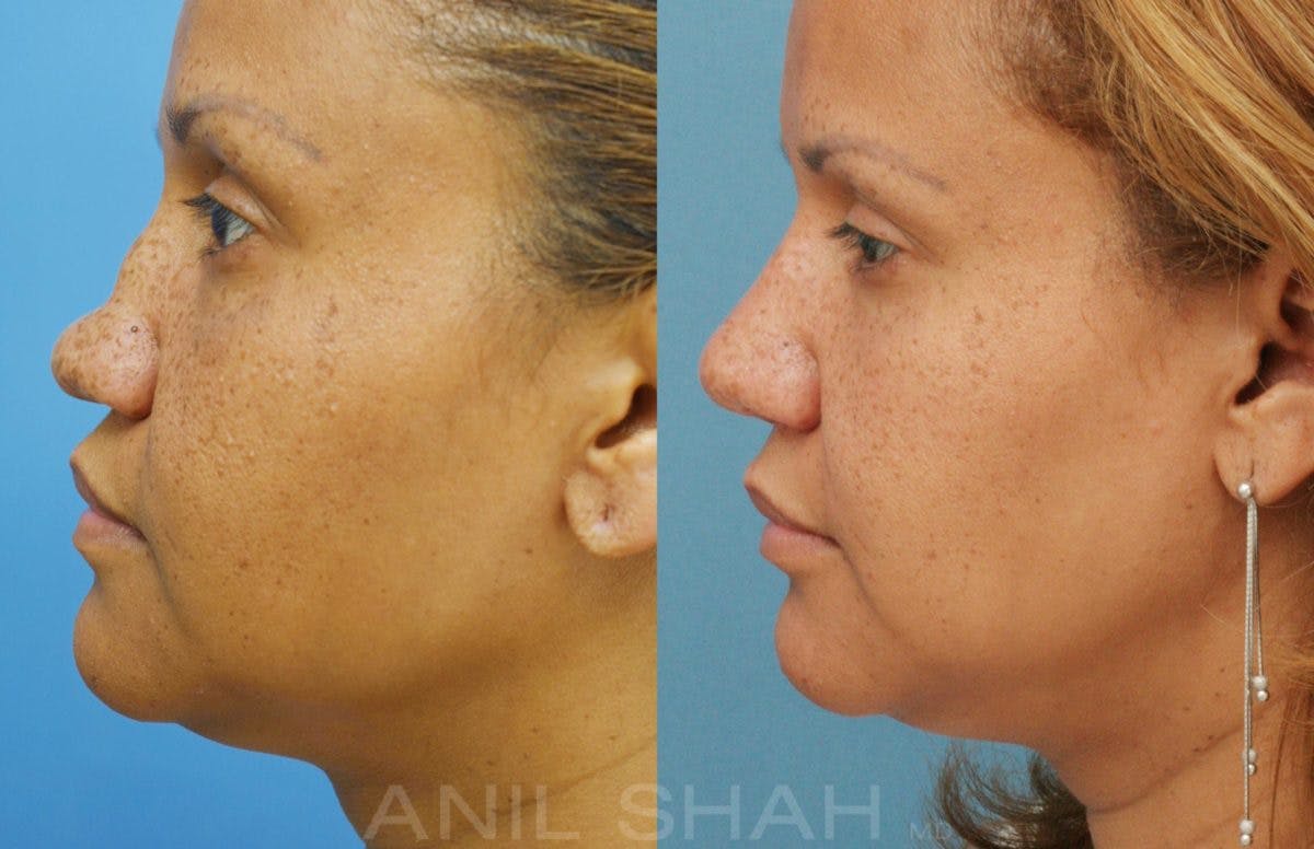 Rhinoplasty Before & After Gallery - Patient 212555 - Image 5