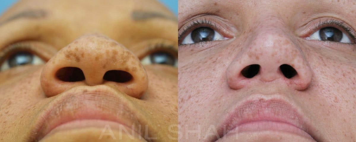 Rhinoplasty Before & After Gallery - Patient 212555 - Image 6