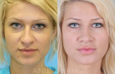 Rhinoplasty Before & After Gallery - Patient 131353 - Image 1