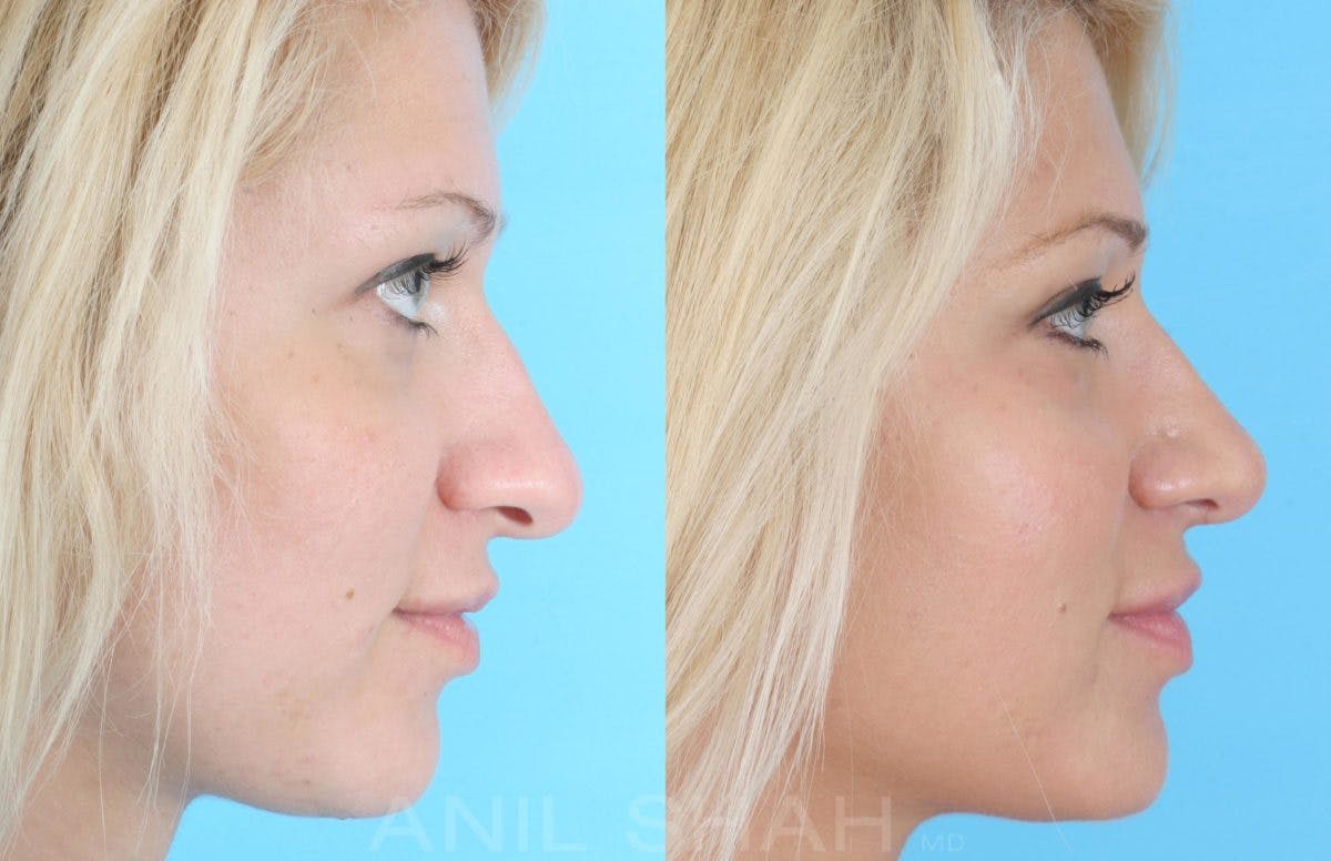 Rhinoplasty Before & After Gallery - Patient 131353 - Image 2