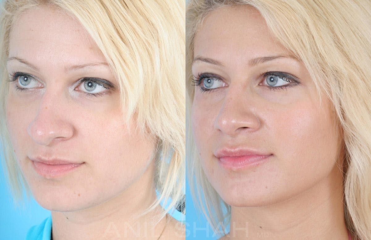 Rhinoplasty Before & After Gallery - Patient 131353 - Image 3