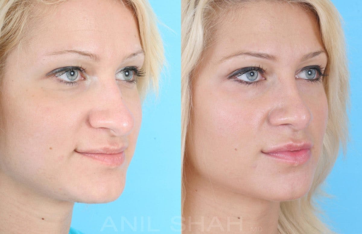 Rhinoplasty Before & After Gallery - Patient 131353 - Image 4