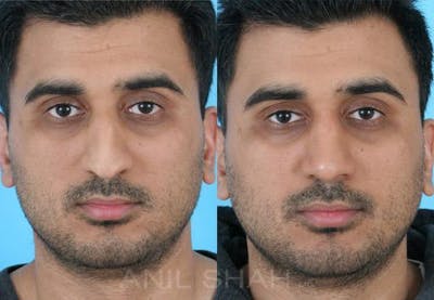 Rhinoplasty Before & After Gallery - Patient 299538 - Image 1